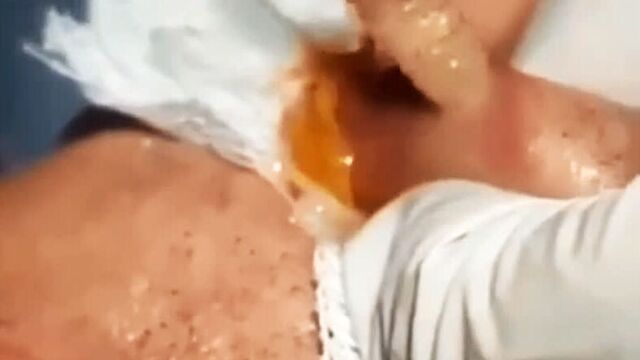 Извлечение личинки овода из губы