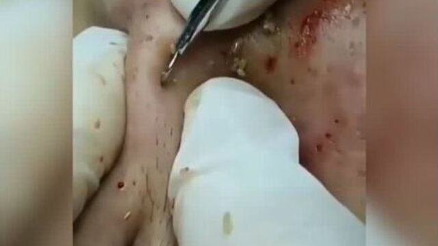 чистка лица