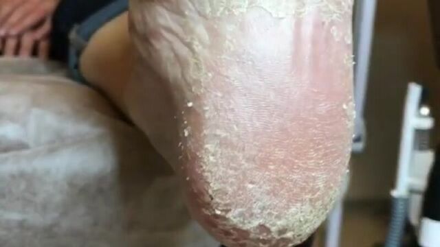 Любые дефекты , которые вы видите на коже стоп -это результат разрушения 1.рогового слоя( 31 слой чешуек) 2.кислотной мантии (PH
